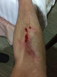 腿受伤图片,紧急救治与康复之路